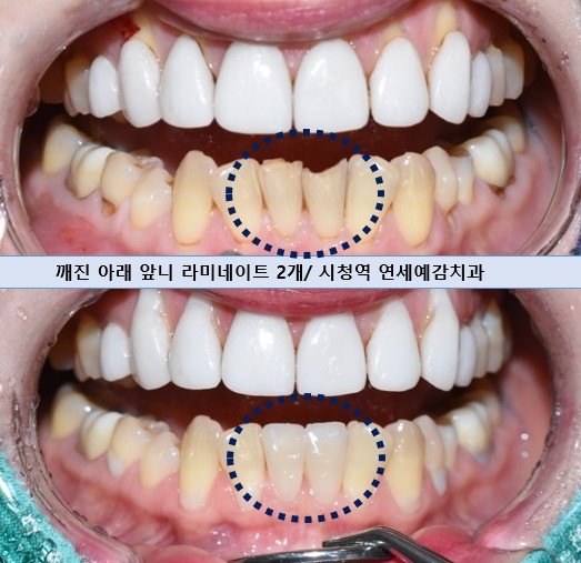 韓国 割れた歯 治療 歯科