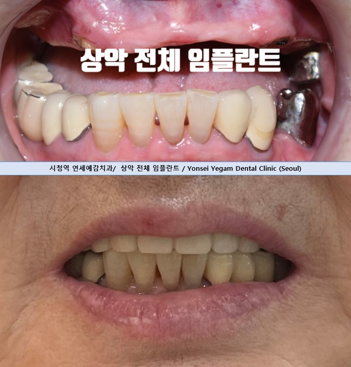 韓国 インプラント 歯科