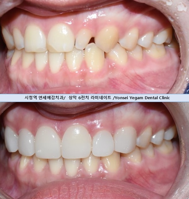 韓国 矮小歯 治療 歯科