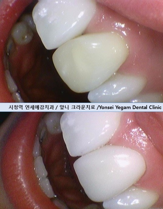 韓国 前歯 変色 治療