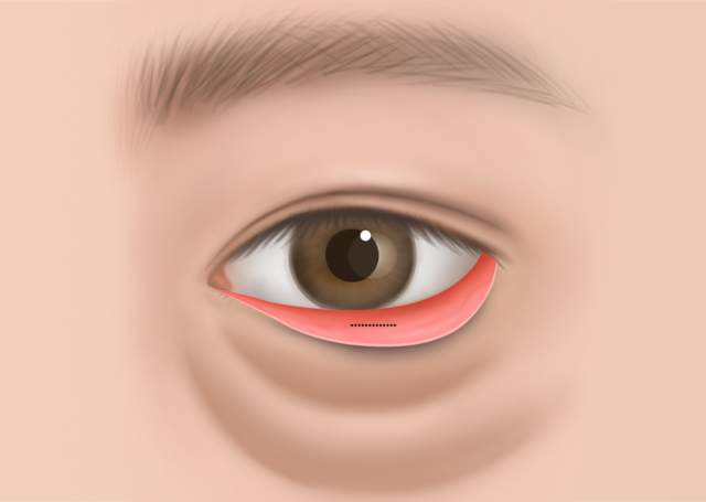 <br><p style="font-size: 20px;">결막 절개</p>