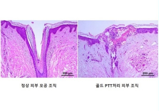 골드PTT 치료 원리 이미지 2