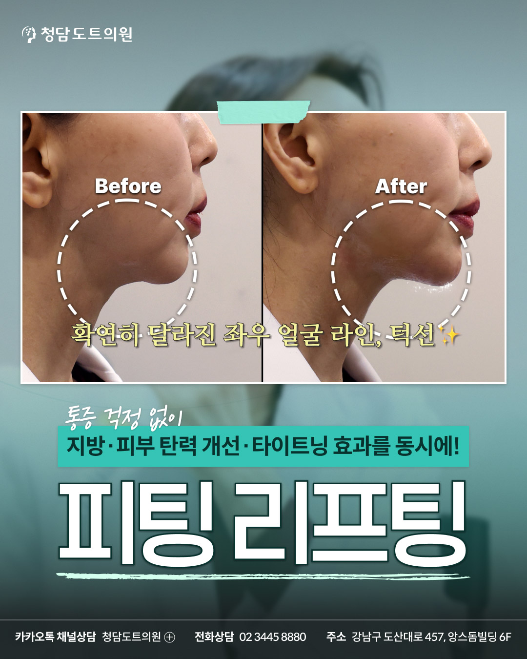 청담도트의원 피팅 리프팅 시술 전후