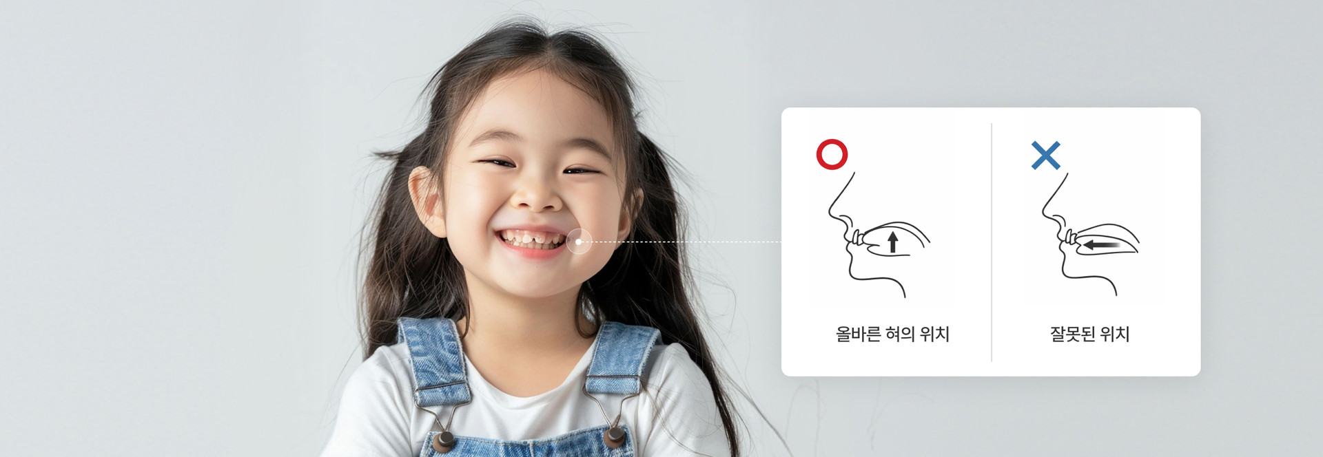 MFT 구강근기능요법 교정 재발 방지 - 송도 디어스마일치과교정과의원