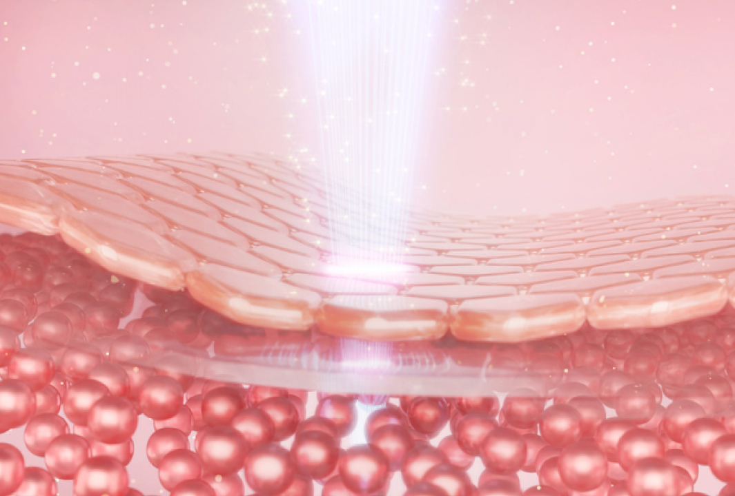 질 타이트닝(Vaginal Tightening) 안내