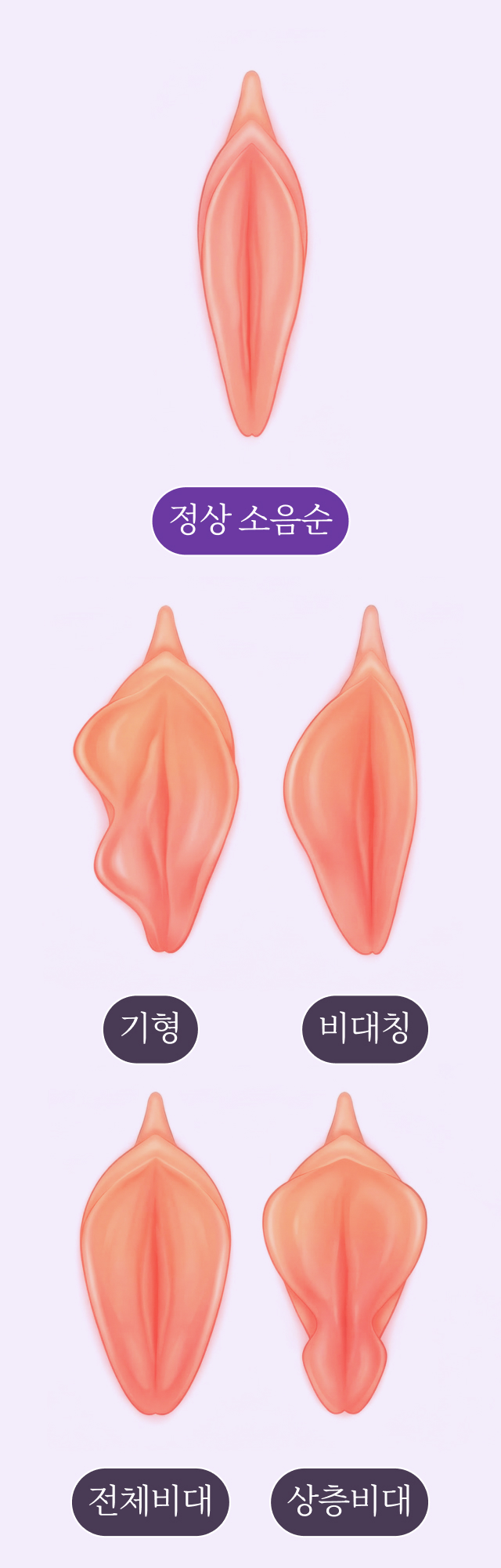 세렌 소음순 성형 프로그램 모습 (Mobile)