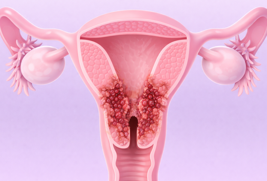 자궁경부암(HPV) 안내