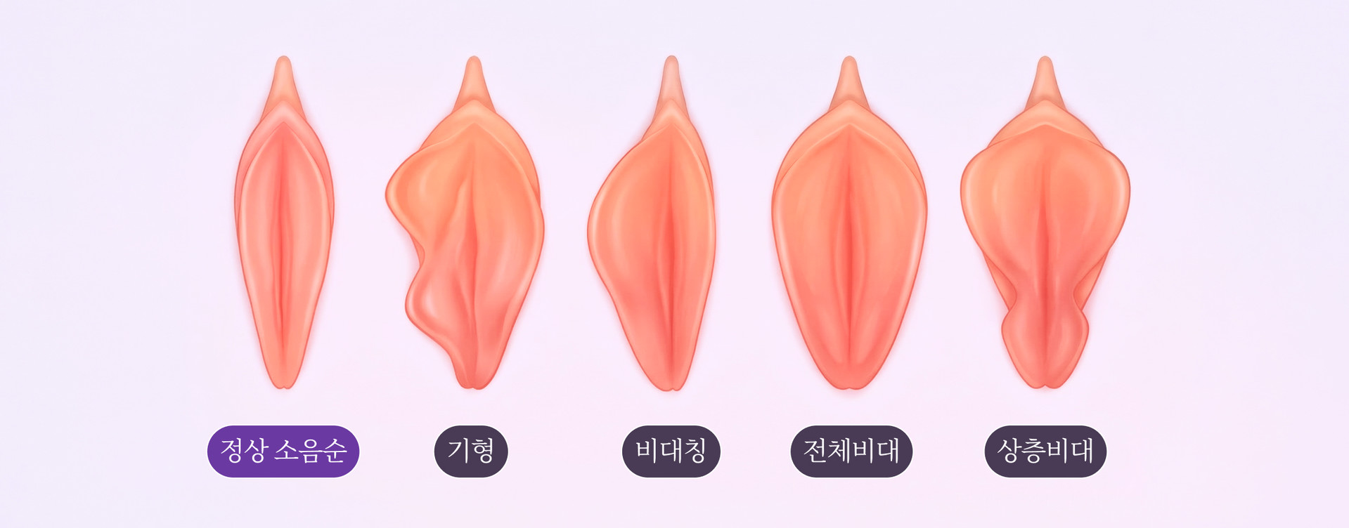 세렌 소음순 성형 프로그램 모습 (PC)