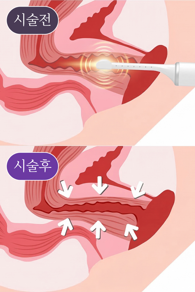 리비브 레이저