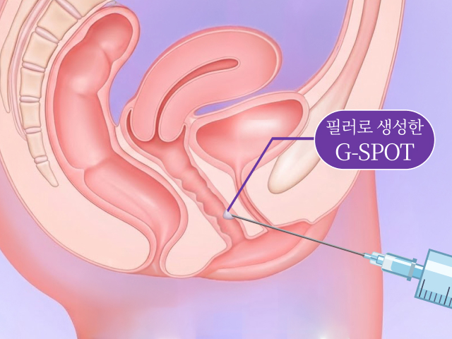 G스팟 필러