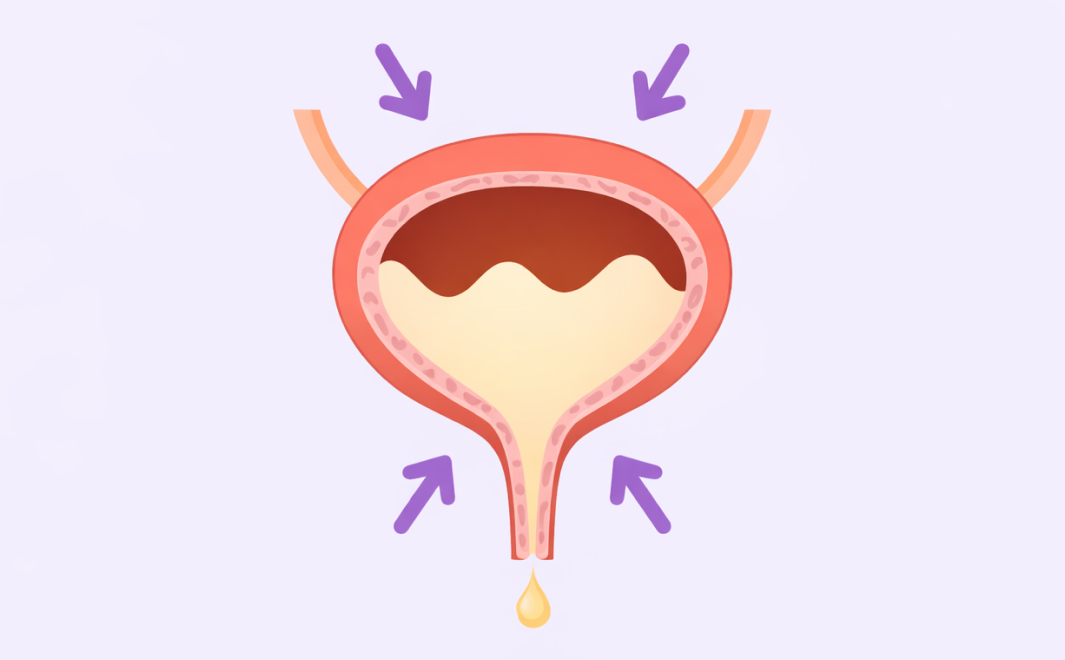 복압성 요실금