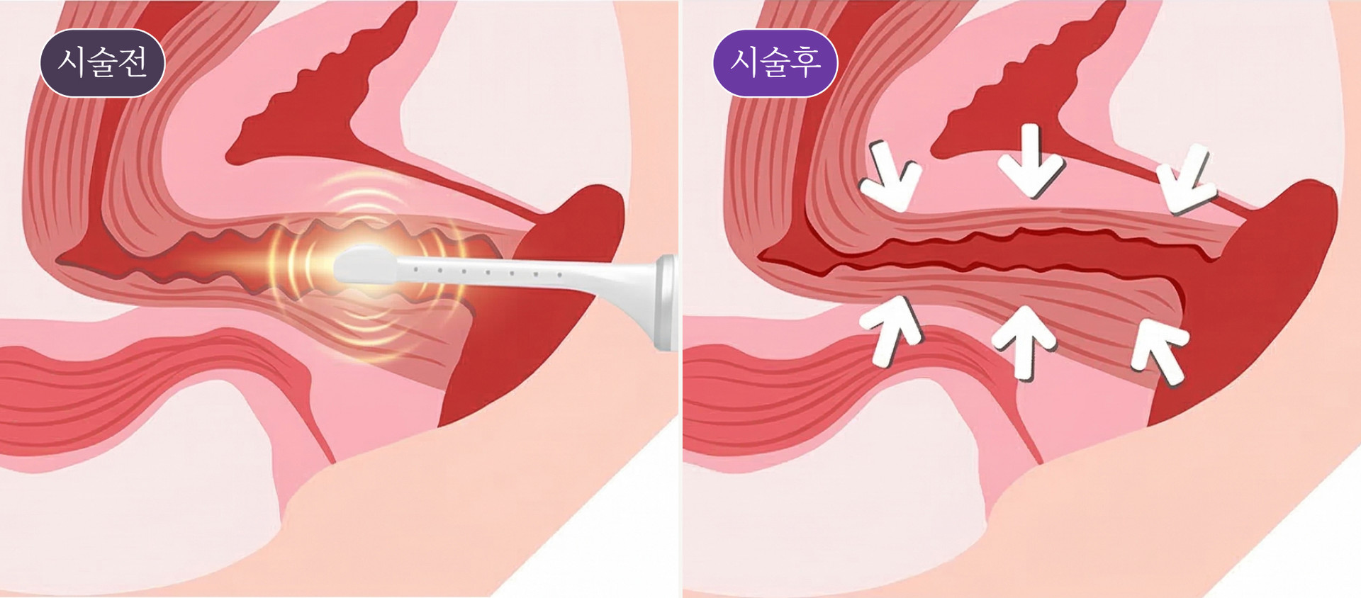 리비브 레이저