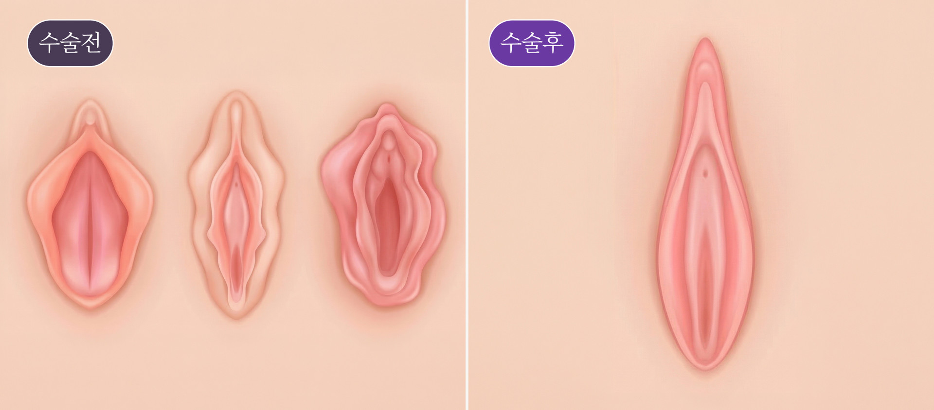 소음순 축소 성형