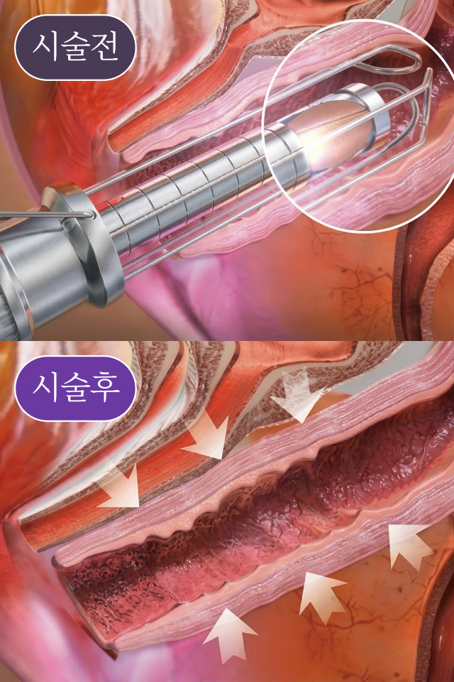 이브로 레이저 치료