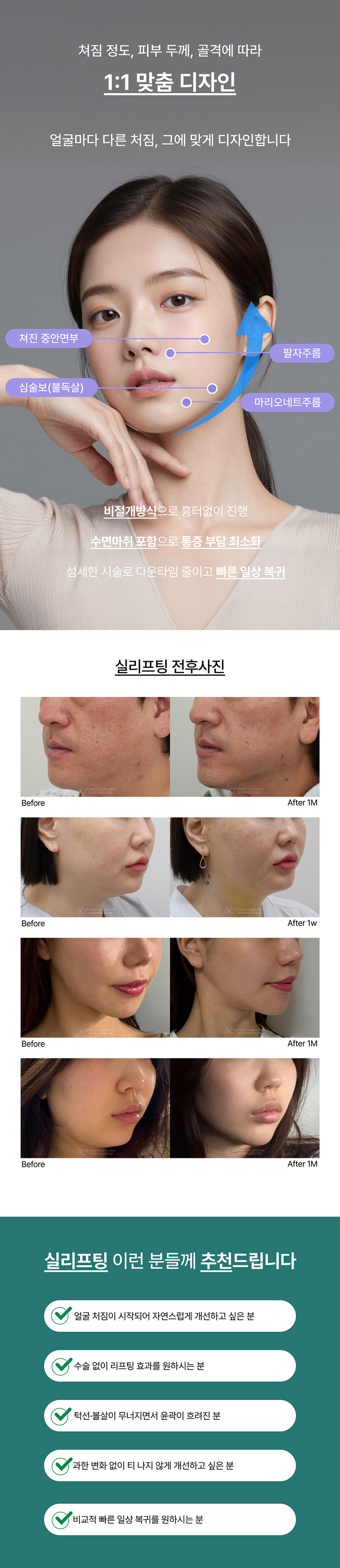 실리프팅 전후 비교, 팔자주름 개선, 마리오네트주름 리프팅, 비절개 리프팅 시술 사례, 자연스러운 얼굴 리프팅 효과, 빠른 회복