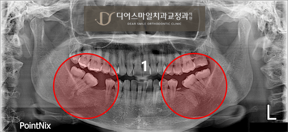 쓰러진 어금니 세우기 업라이팅 교정 사례 - 송도 디어스마일치과교정과의원