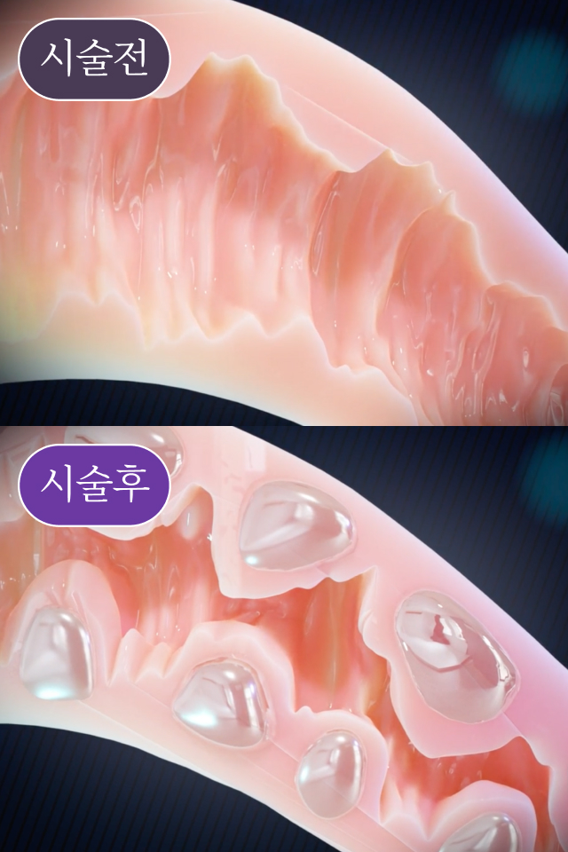 질 입구 필러