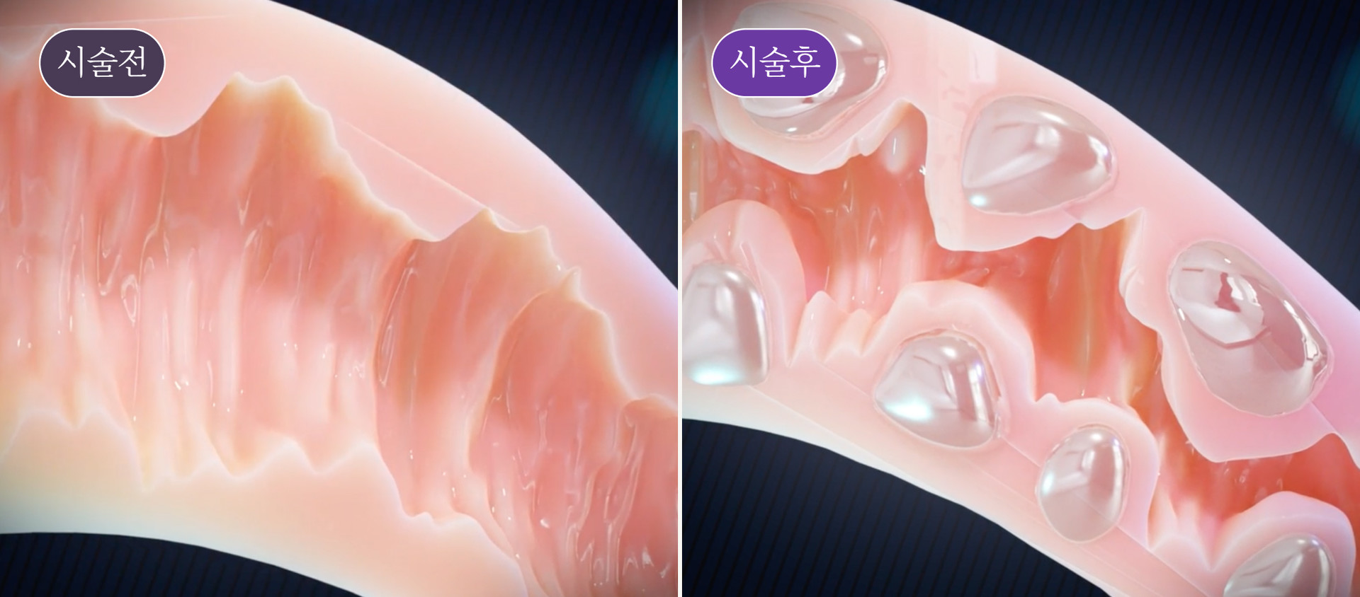 질 입구 필러