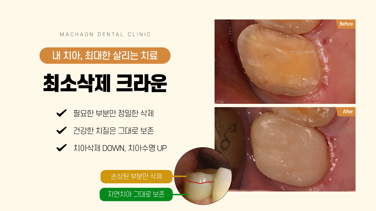 최소삭제 크라운
