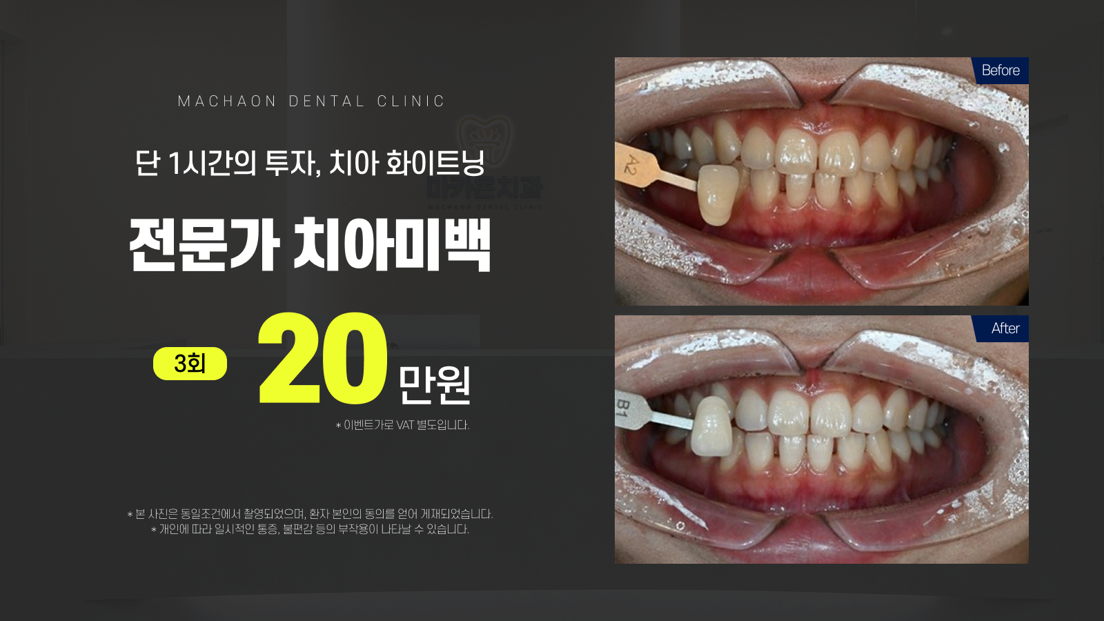 전문가 치아미백 3회 20만원
