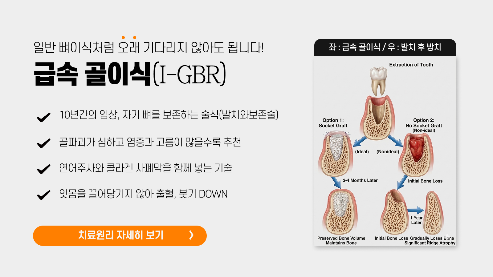 급속 골이식(I-GBR) - 치료원리 자세히 보기