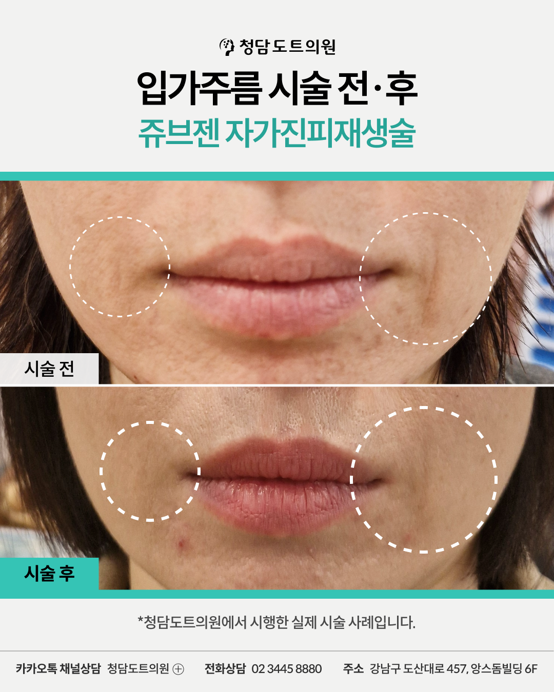 청담도트의원 쥬브젠 입가주름 시술 전후