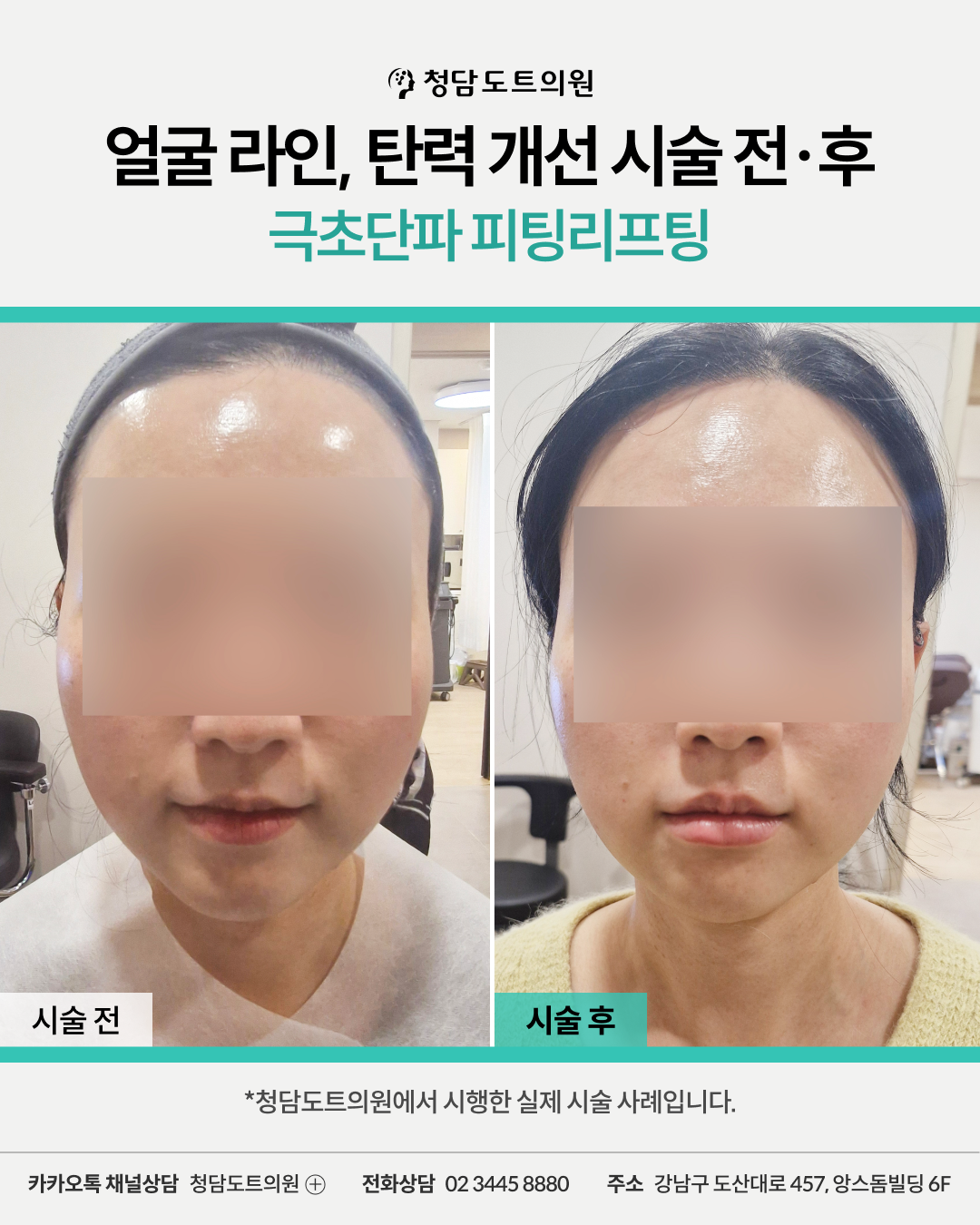 청담도트의원 피팅 리프팅 시술 전후