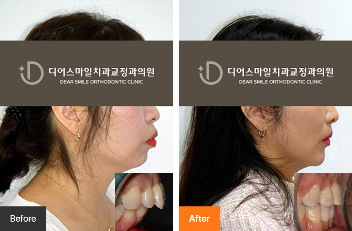 중년 돌출입 발치 교정 사례 - 송도 디어스마일치과교정과의원