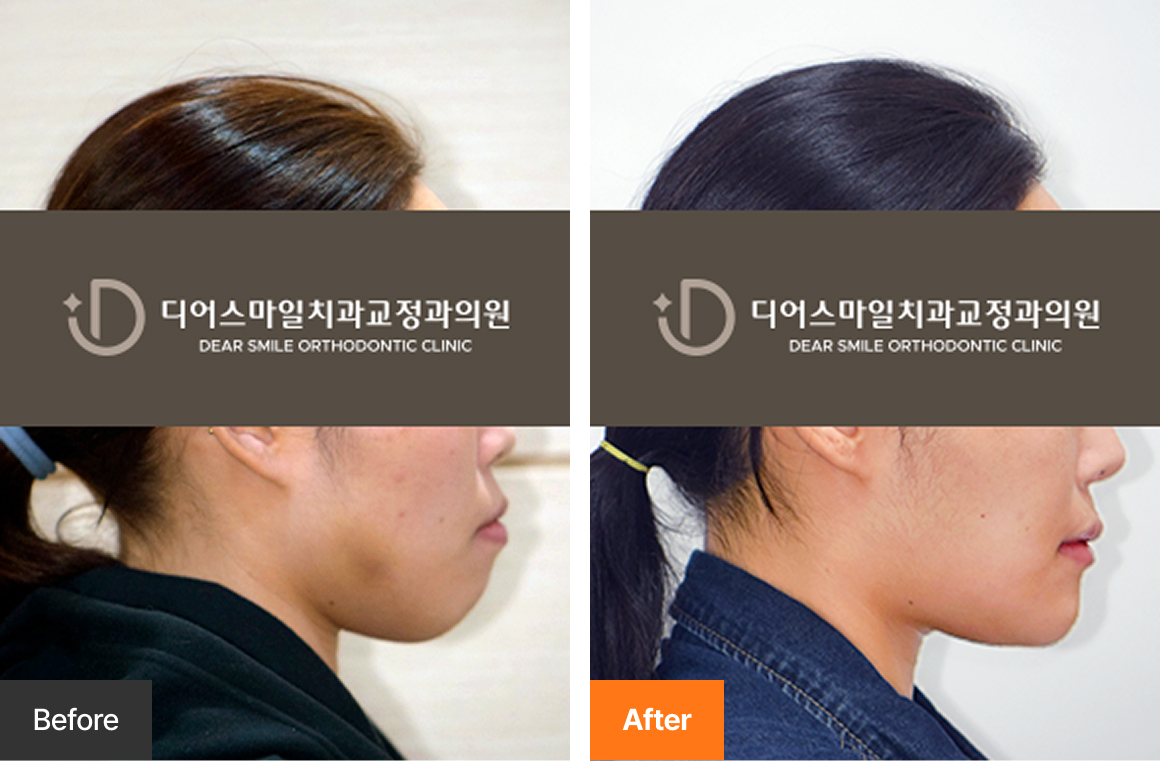 성인 돌출입 발치교정 MFT 사례 - 송도 디어스마일치과교정과의원