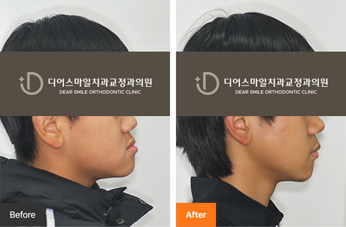 사춘기 주걱턱 페이스마스크 악궁확장 교정 사례 - 송도 디어스마일치과교정과의원