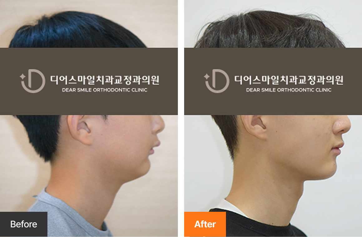 무턱 하악성장유도장치 트윈블록 청소년 교정 사례 - 송도 디어스마일치과교정과의원