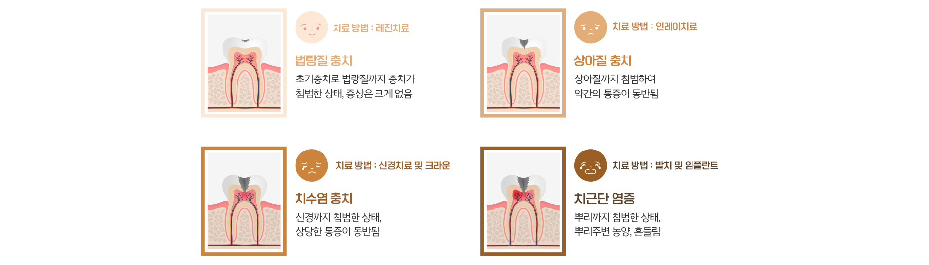 수락산역 연세더튼튼치과에서 알려드리는 충치의 진행단계와 치료방법
