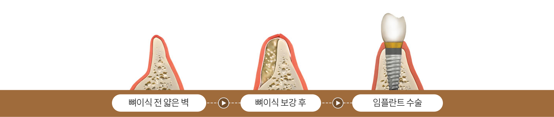 망월사역 연세더튼튼치과 뼈이식 임플란트
