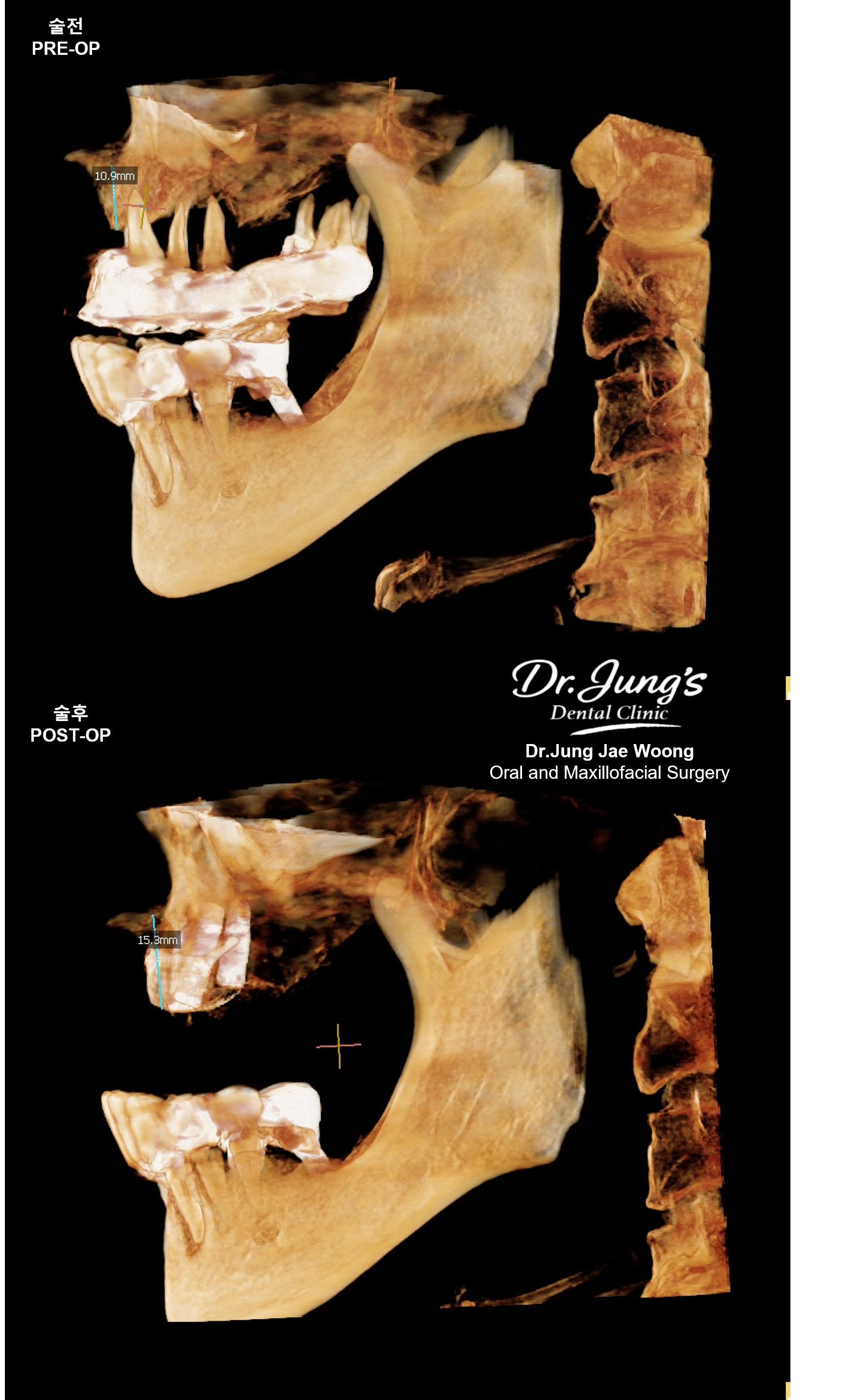 Bone grafting 3D CT Dr. Jung's Dental Clinic Jeju