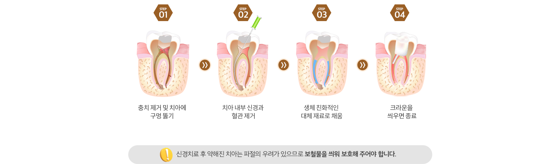 망월사역 연세더튼튼치과에서 알려드리는 신경치료 단계별 치료과정