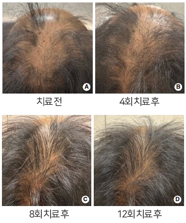 탈모치료