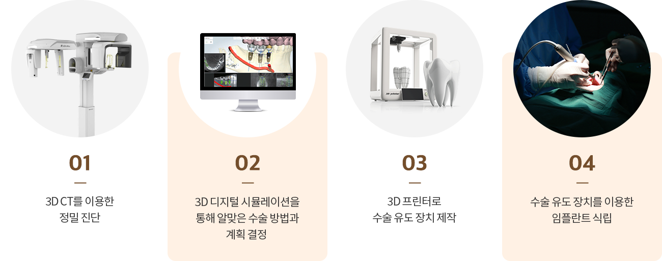 수락산역 연세더튼튼치과 디지털 임플란트 과정