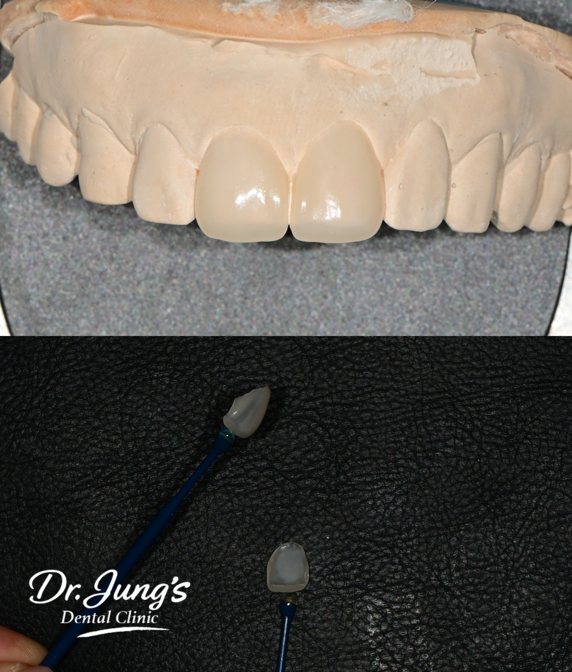 Laminate prosthetics Dr. Jung's