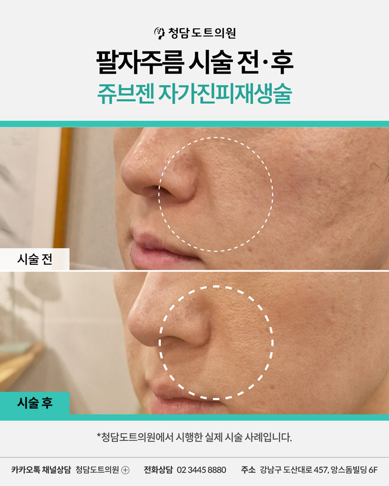 청담도트의원 쥬브젠 팔자주름 시술 전후