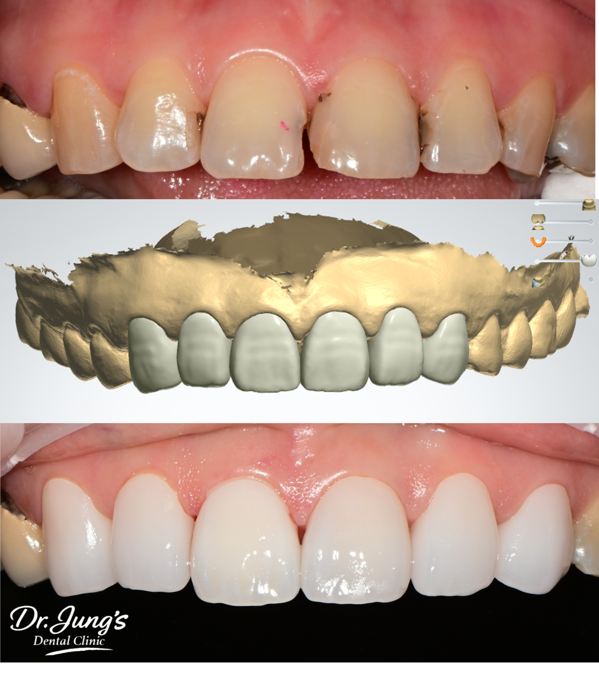 Zirconia crown Dr. Jung's