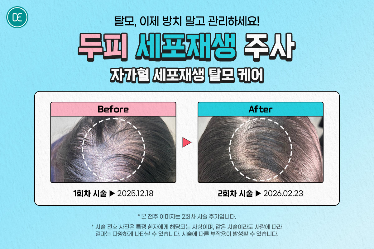 PRP두피