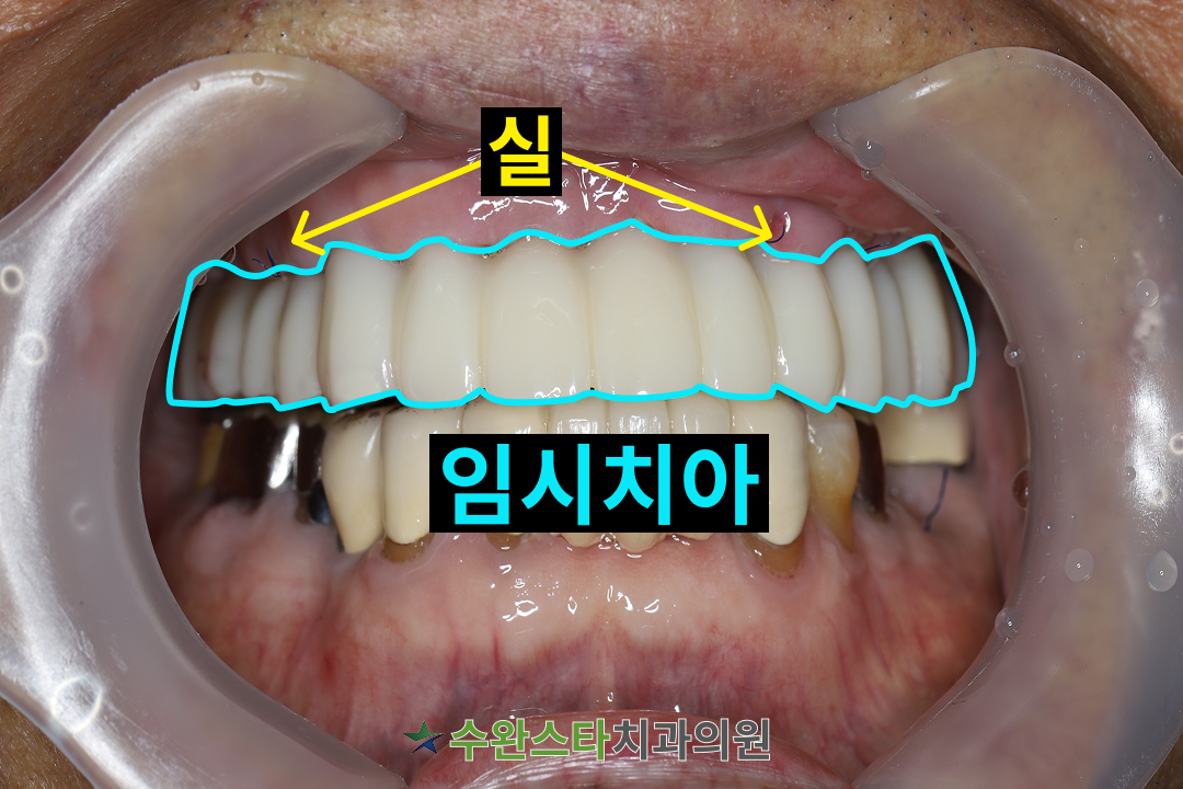 수술 2일 후 임시치아, 80대 남성 (2026.1 촬영)
