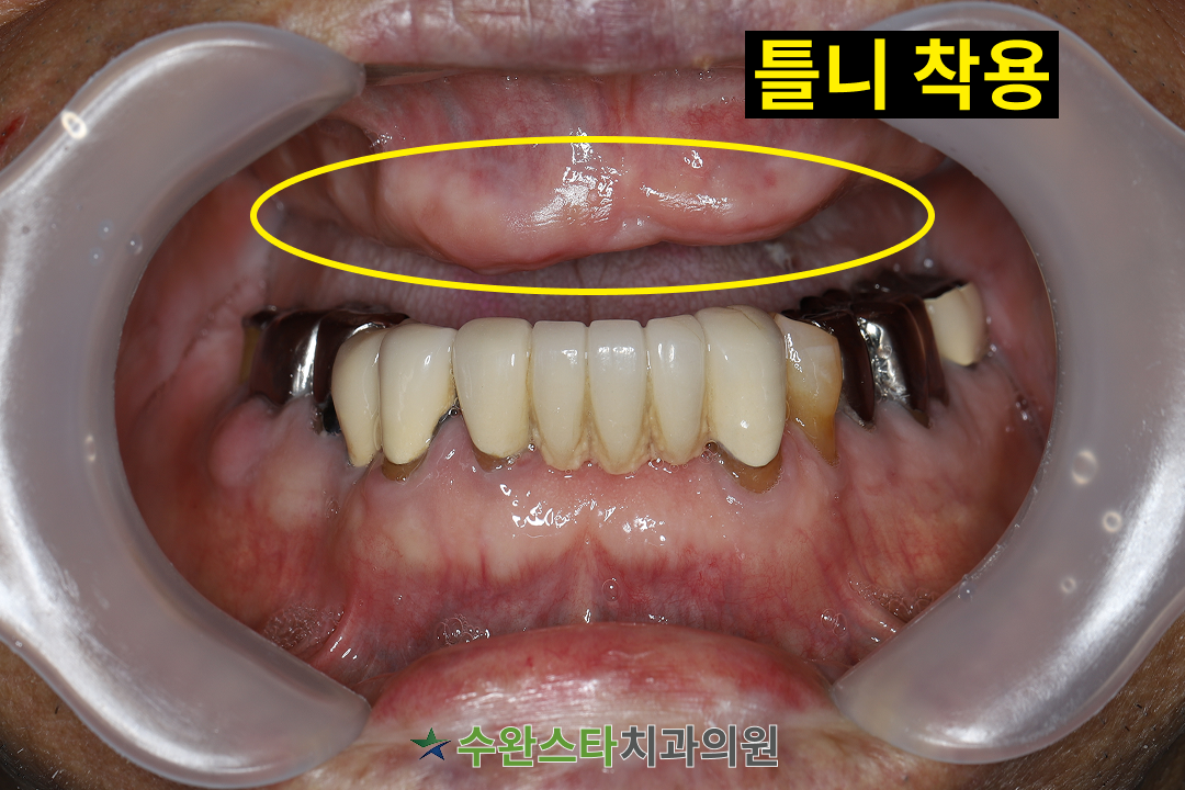 처음 내원 시 구강 내부 사진, 80대 남성 (2026.1 촬영)  ​