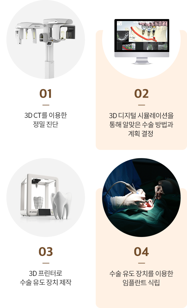 수락산역 연세더튼튼치과 디지털 임플란트 과정