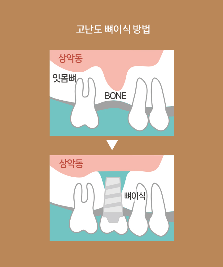 고난도 뼈이식 방법