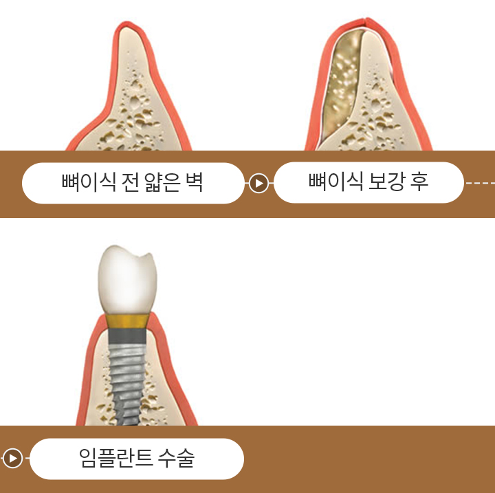 망월사역 연세더튼튼치과 뼈이식 임플란트