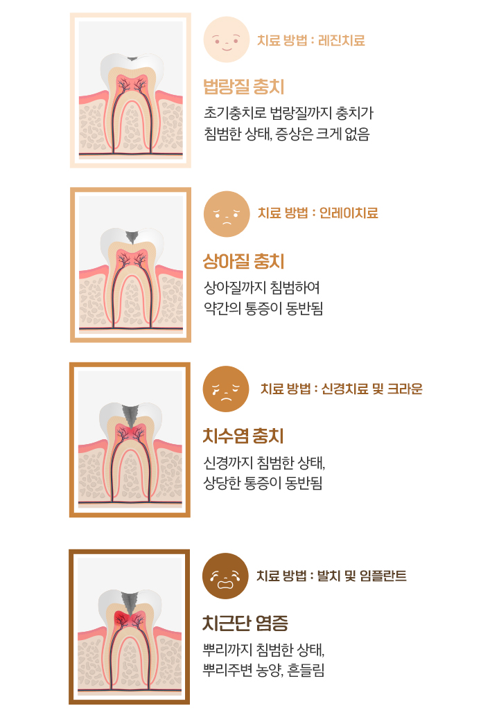 수락산역 연세더튼튼치과에서 알려드리는 충치의 진행단계와 치료방법