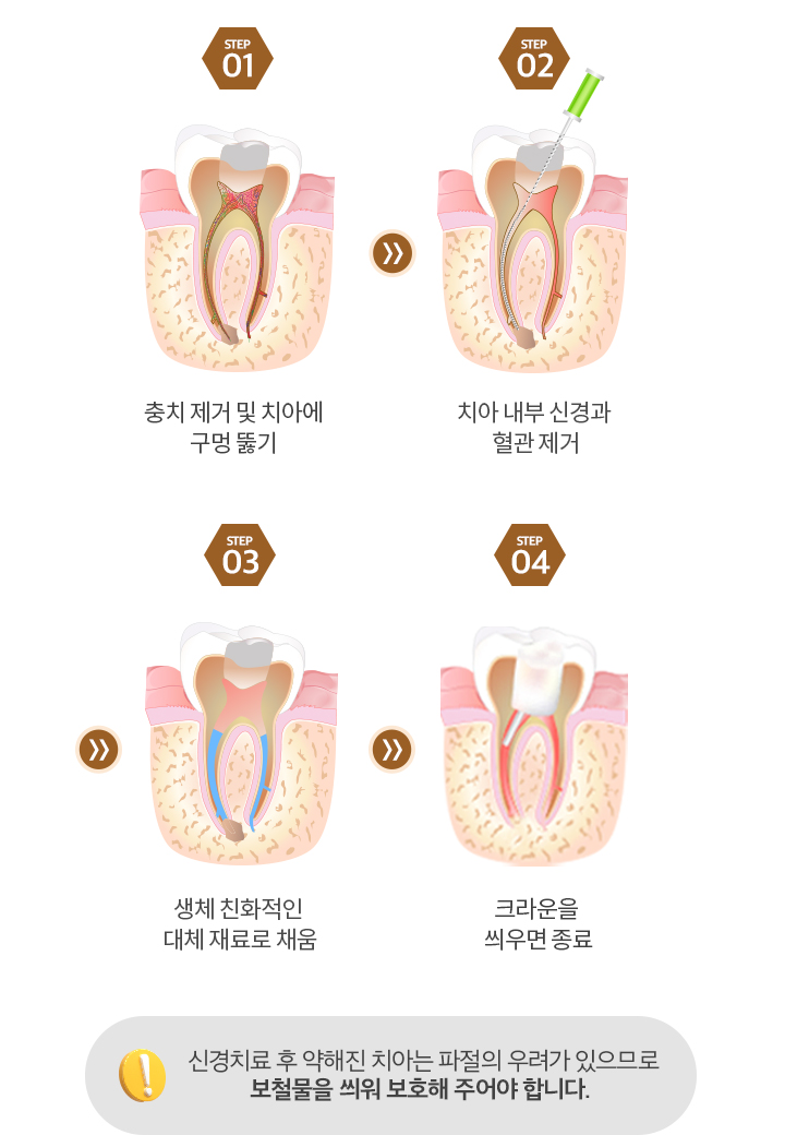 망월사역 연세더튼튼치과에서 알려드리는 신경치료 단계별 치료과정