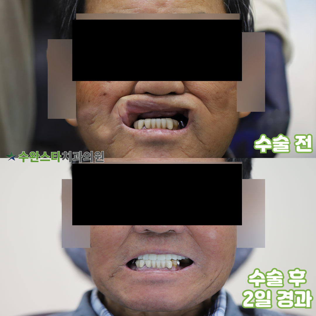 수술 전 / 수술 후 2일 경과, 80대 남성 (2026.1 촬영)