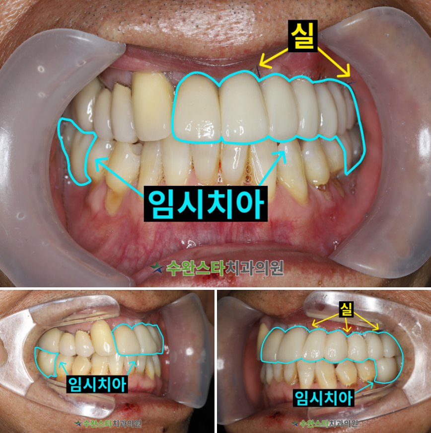 수술 2일 후 임시치아, 50대 남성 (2026. 3 촬영)  ​